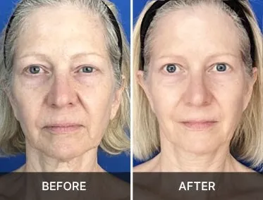 Total Package Serum before and after skin appearance